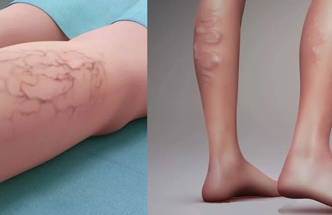 Varices