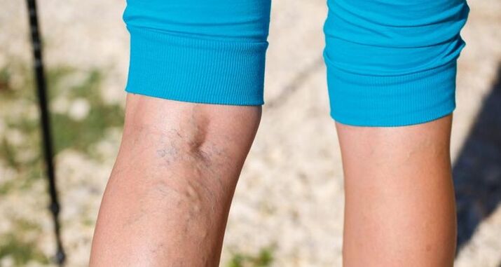 Varices nas pernas