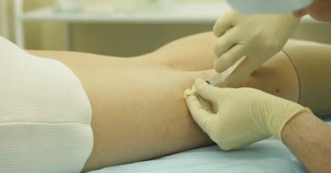 Tratamento das varices nas mulleres