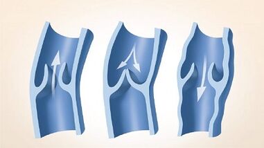 varices das extremidades inferiores