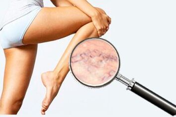 Varicosis das pernas