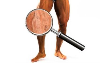 Veas xirando para varices