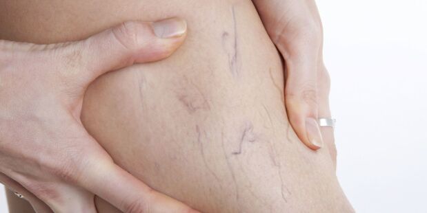 Varices nas pernas