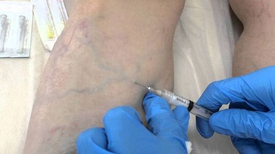 escleroterapia para varices nas pernas nas mulleres