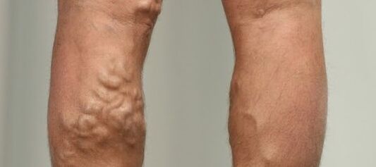 varices na perna