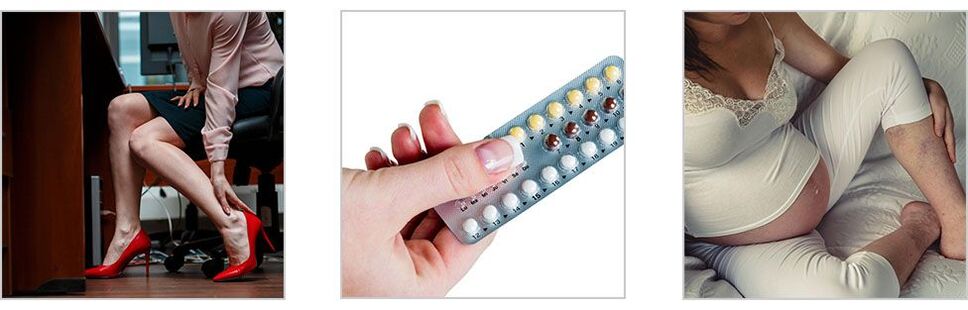 causas de varices nas pernas