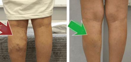 resultados do tratamento de varices nas pernas