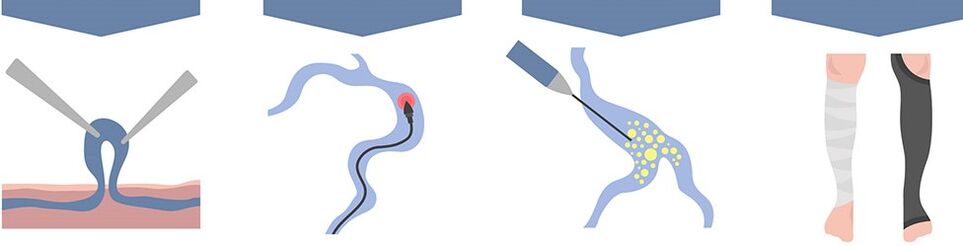 tipos de tratamento para varices