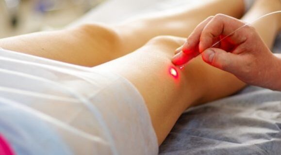 Coagulación con láser para varices das extremidades inferiores