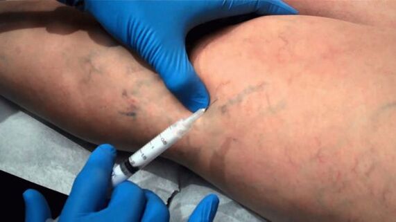 Escleroterapia para varices