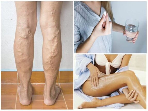 Métodos de tratamento para varices nas pernas