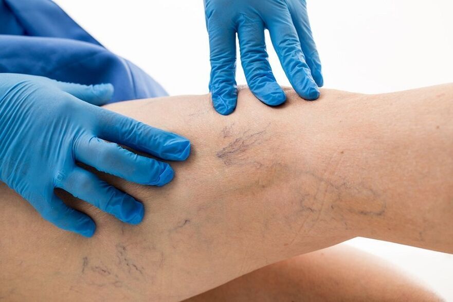 exame de pernas para varices