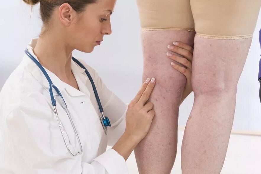 médico examina as veas para as varices