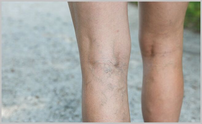veas das pernas saíntes con varices