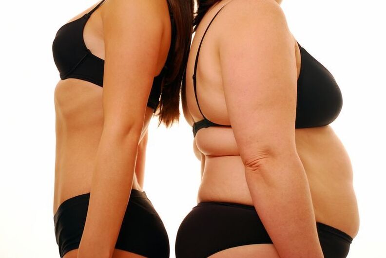 corpo delgado e obesidade como causa de varices