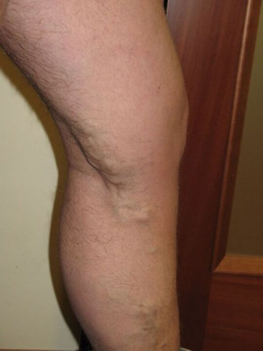 fase avanzada de varices