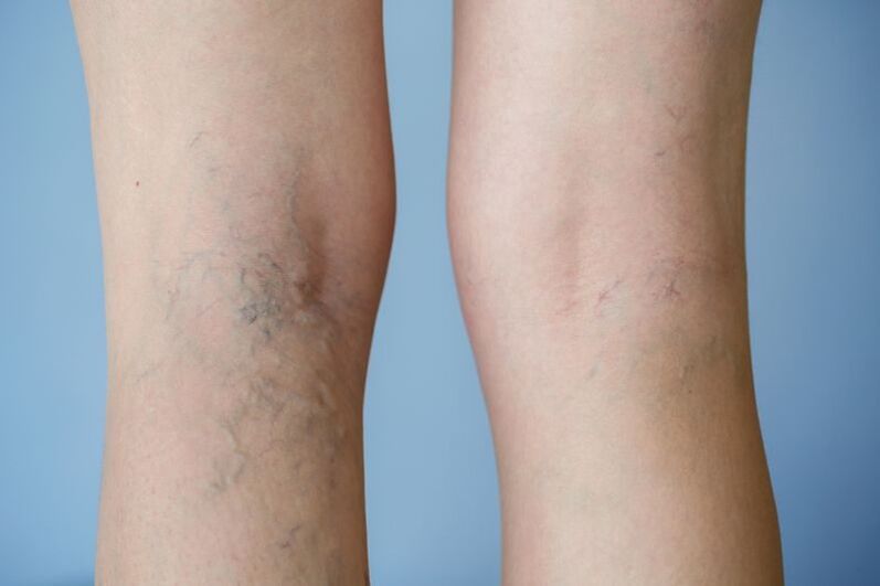 foto de varices nas pernas