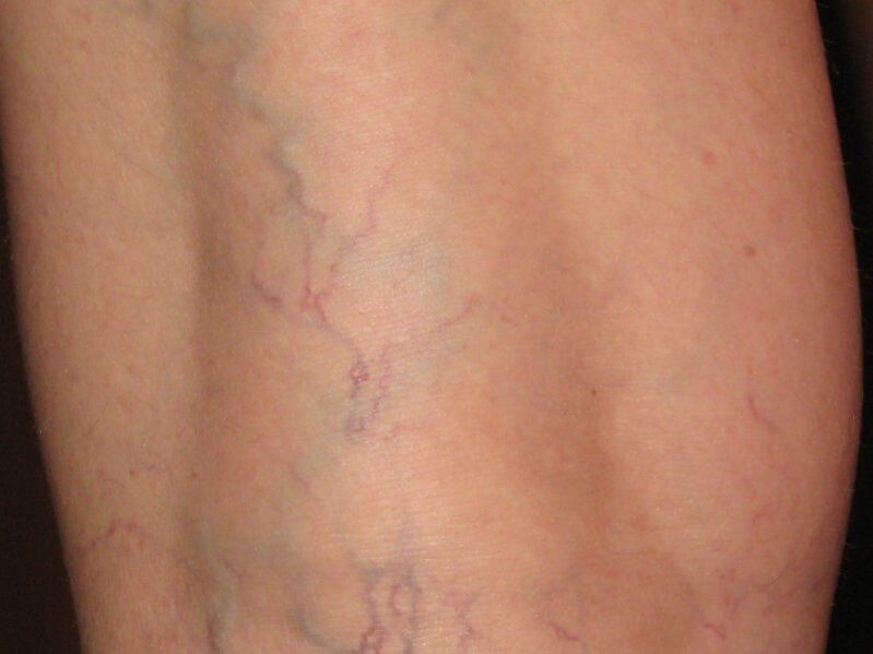 signos de varices nas pernas
