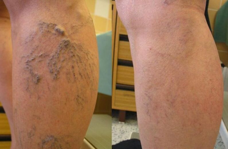 varices iniciais e avanzadas