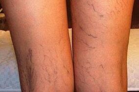 foto de varices nas pernas