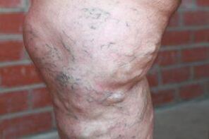 varices avanzadas