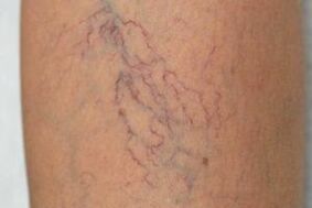 varices